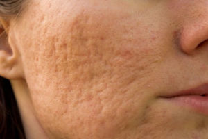Como amenizar as marcas de acne?